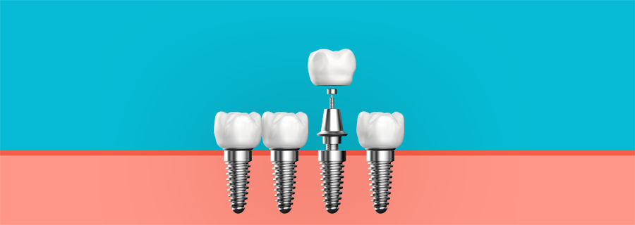 뼈이식 임플란트
