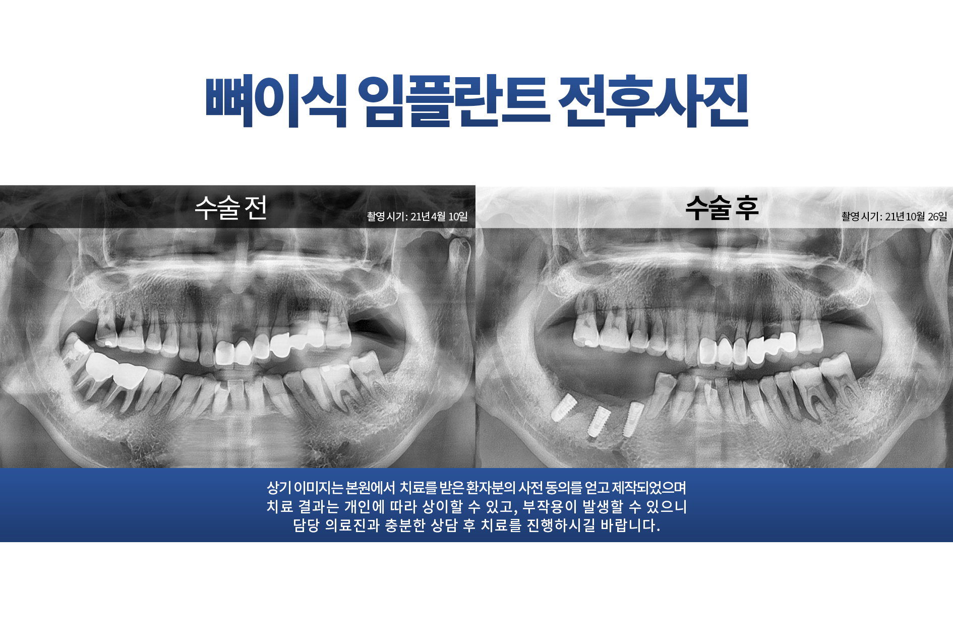 뼈이식 임플란트