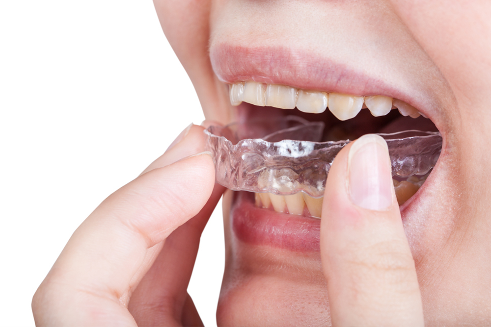 교합 안전장치 (스플린트)