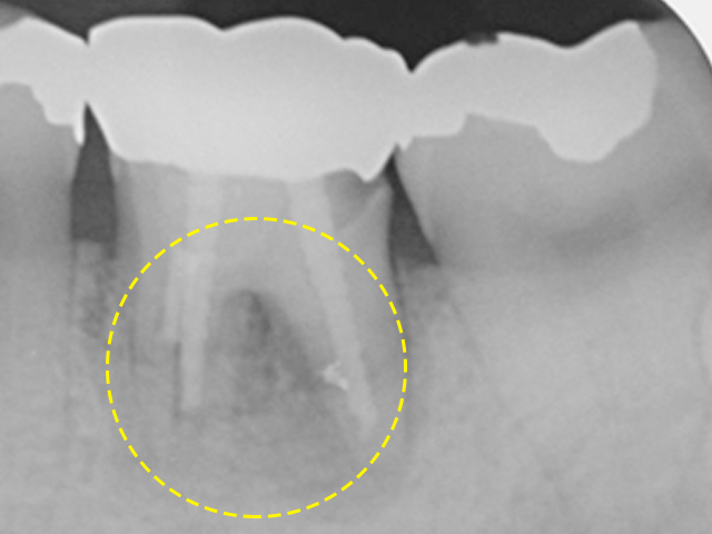 자연치아살리기