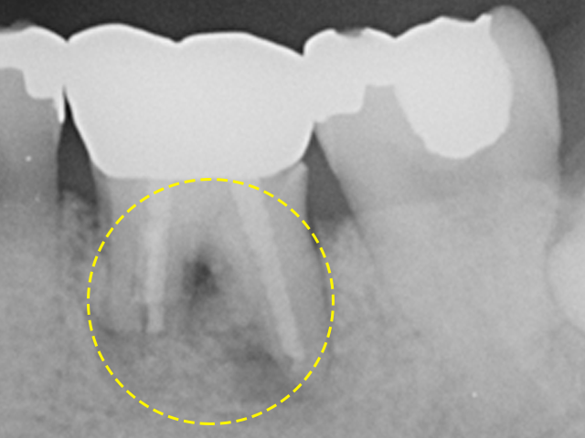 자연치아살리기