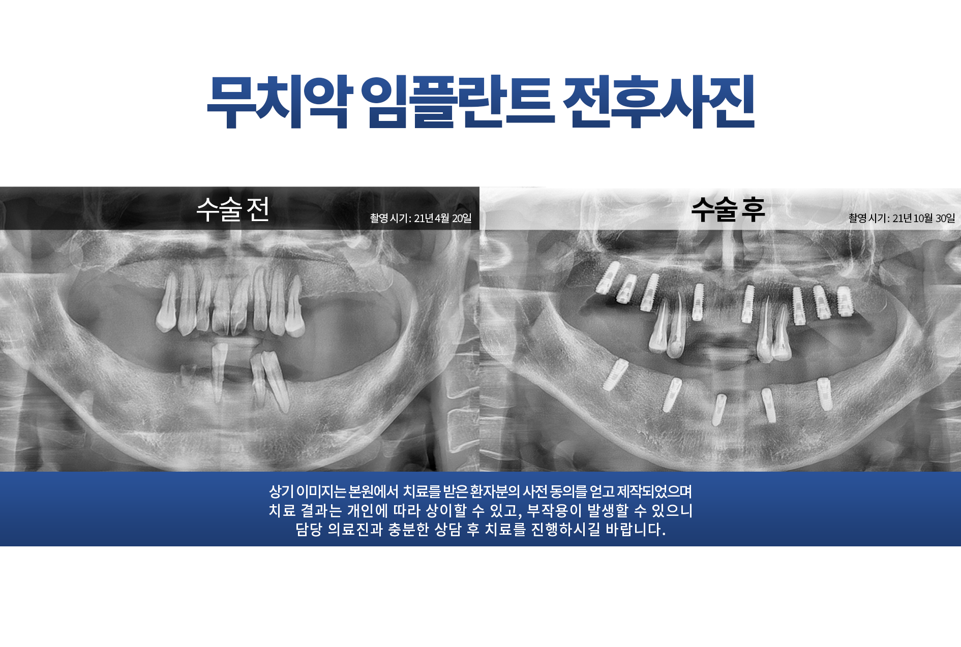 무치악 임플란트