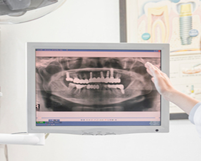 레이저 임플란트