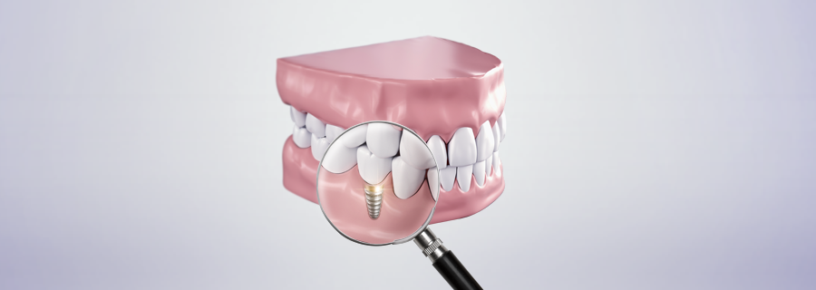 최창수 치과 임플란트