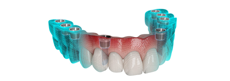 네비게이션 임플란트