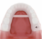 네비게이션 임플란트