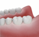 3. 수술 당일 임시보철 가능